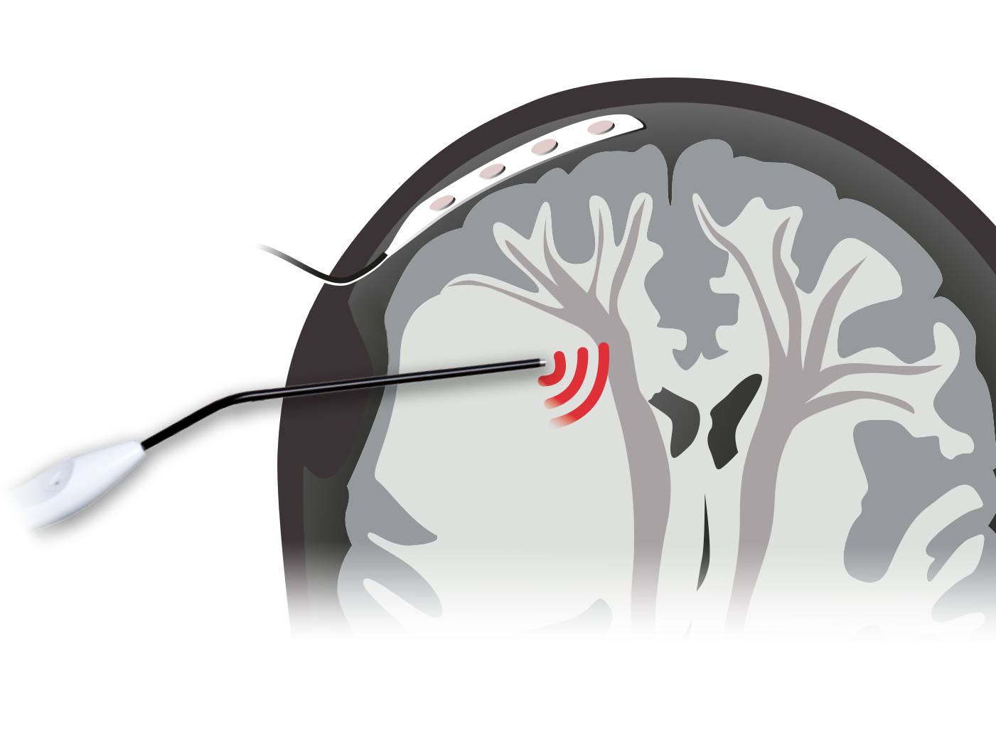 Illustration: Mappingsauger im Einsatz Illustration: Mappingsauger im Einsatz